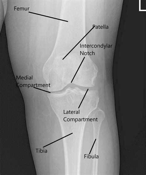 Types Of Knee Pain Anterior Posterior Medial Lateral