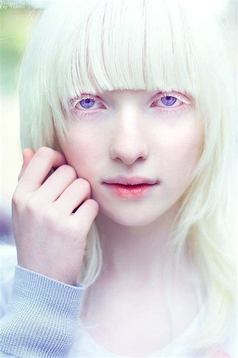 Albino | Albino model, Albino girl, Albinism