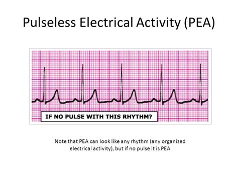 Pulseless Electrical Activity (PEA) Diagram | Quizlet