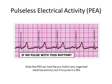 Pulseless Electrical Activity (PEA) Diagram | Quizlet