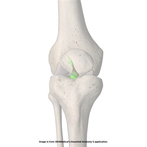 ACL Tear/Sprain