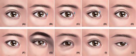 Category of upper eyelid morphology and the preferred double eyelid shape in Asians according to ...