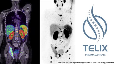 Telix Granted TGA Priority Review for Prostate Cancer Imaging - Telix Pharmaceuticals