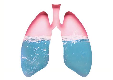 Neurogenic Pulmonary Edema | Causes, Symptoms and Treatment - Healthella