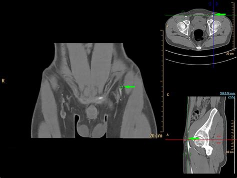 Comparative Study of Three Preoperative Imaging Modalities for the Evaluation and Design of ...