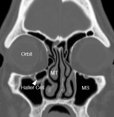 Ethmoid Sinus: Normal Anatomy & Variants