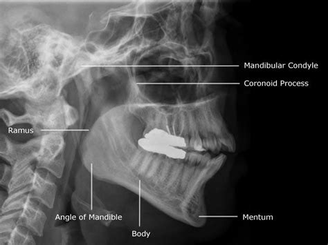 Radiographic Anatomy of Facial Bones | Radiology, Medical radiography ...