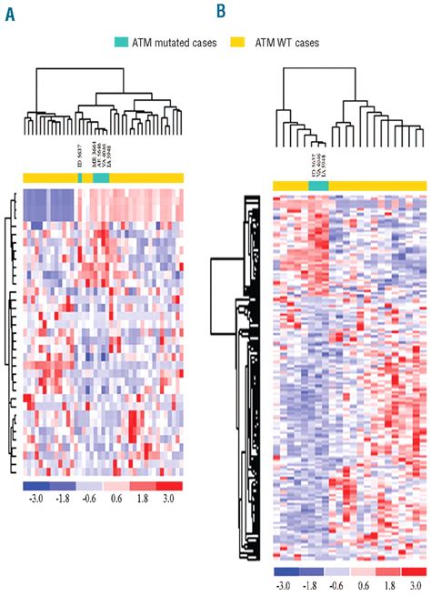 ATM gene alterations in chronic lymphocytic leukemia patients induce a distinct gene expression ...