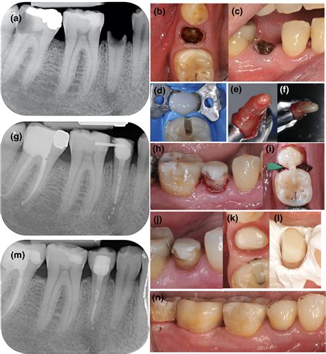 Clinical procedures and outcome of surgical extrusion, intentional replantation and tooth ...