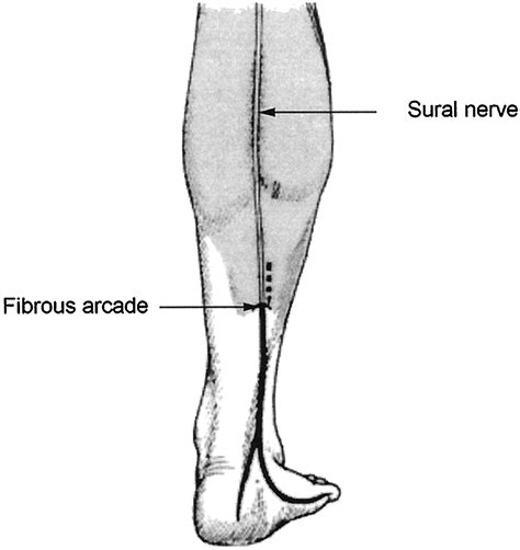 The Sural Nerve: Anatomy, and entrapment | Functional Anatomy Seminars ...