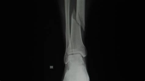 Compound Fracture X Ray