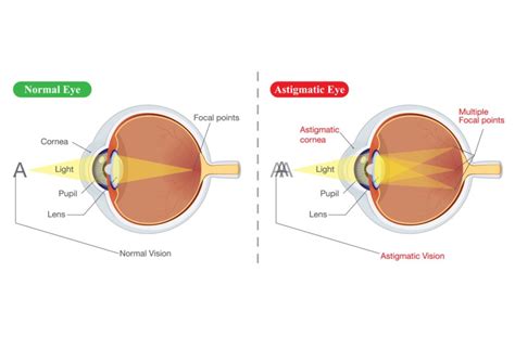 What Is Astigmatism?｜Missouri｜Family Focus Eyecare