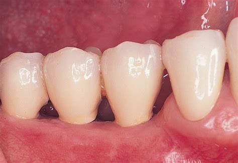 2: Surgery of the posterior mandible | Pocket Dentistry