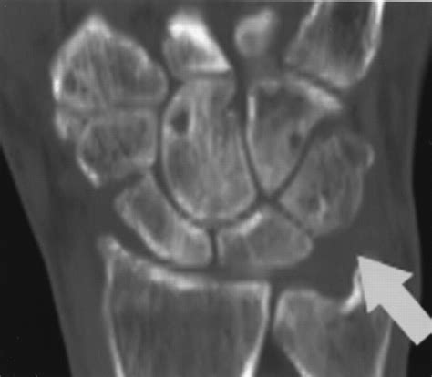 Triquetral Fracture