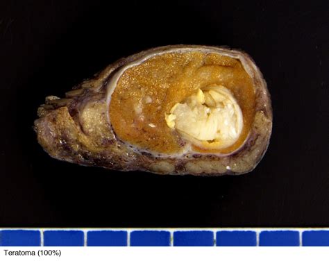 Pathology Outlines - Teratoma