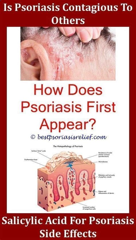 Psoriasis Diet Scalp Psoriasis How To Treataloe vera for psoriasis.Psoriasisc…