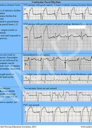 12 Lead ECG Reference Chart (PDF) – Cardiovascular Nursing Education Associates