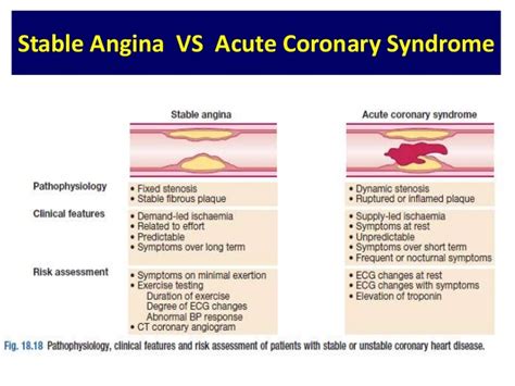 Stable Angina vs. Acute Coronary Syndrome – Monica Benjamin, PA-S