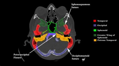 Temporal Bone Imaging