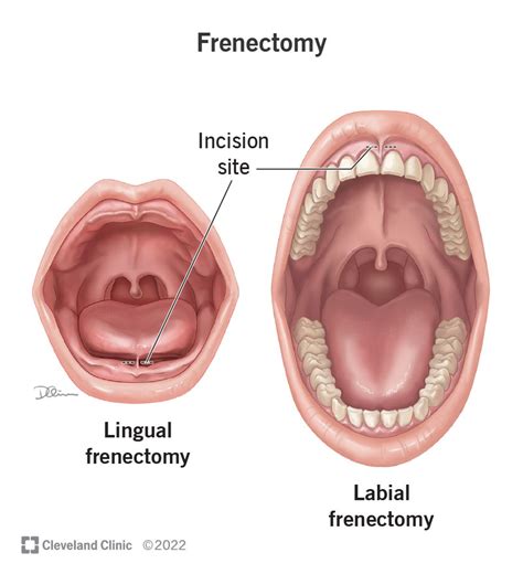 Frenectomy (Tongue-Tie Surgery): Procedure & Recovery