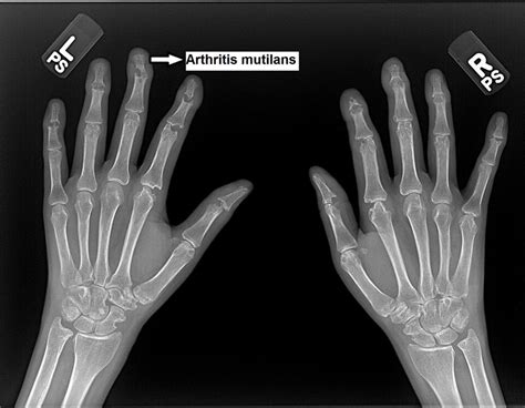 Psoriatic Arthritis - Causes, Symptoms, Diagnosis, Diet & Treatment