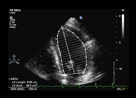 Andrew R. Houghton: Is a left ventricular ejection fraction of 50% 'normal'?