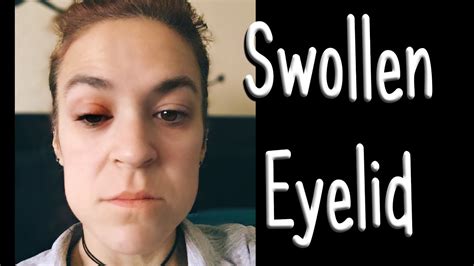 Swollen Eyelid from eye liner NOT a Stye - YouTube