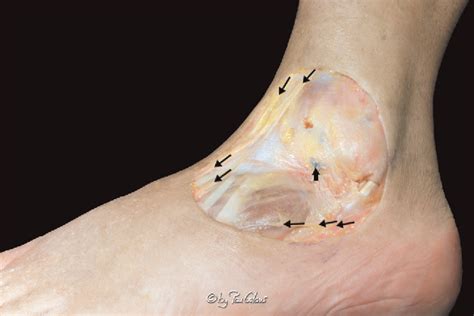 Inferior extensor retinaculum | Semantic Scholar