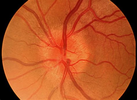 Optic Neuritis - Pictures, Symptoms, Causes, Diagnosis, Treatment | HubPages