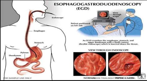 Lower Endoscopy Procedure