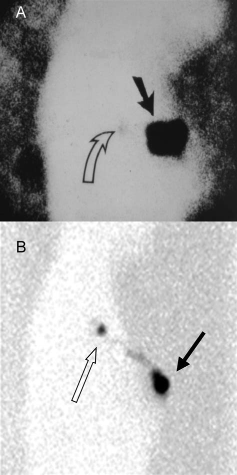 Lymphoscintigraphy and triangulated body marking for morbidity reduction during sentinel node ...