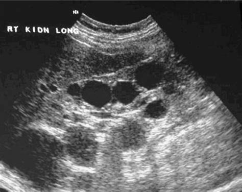 Renal Cortical Cyst Ultrasound