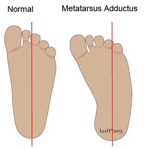 Metatarsus Adductus - Orthoanswer