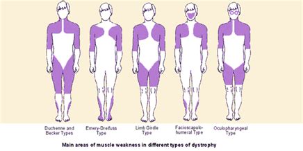 Muscular Dystrophy- Symptoms,Causes,Types,Diagnosis and Treatment