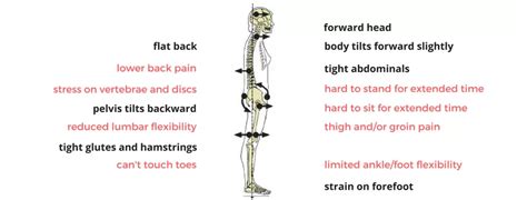 Flat Back Posture - Cause, Symptoms, Treatment, Exercise