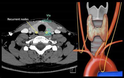 The Radiology Assistant : Cervical Lymph Node Map