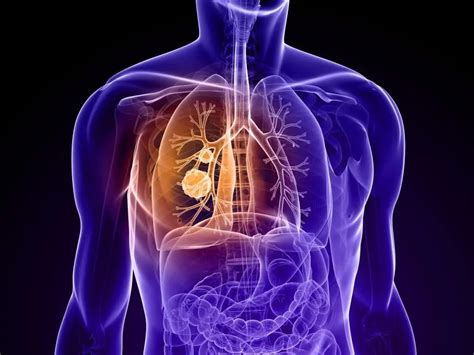 Non-small cell lung cancer: causes, diagnosis, stages of the disease, treatment and prognosis ...