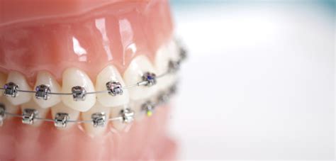 What is Orthodontics? Orthodontics Dentists in the Lower Mainland