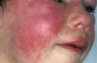 Scarlatina Rash Pictures | Medical Pictures