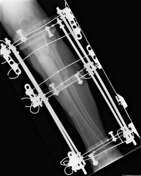 Fracture Fixation: a gallery