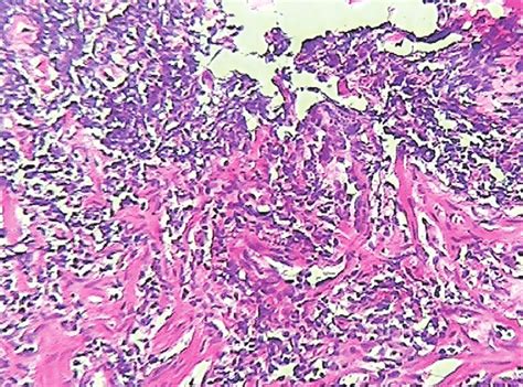 Biopsy of colon demonstrated necrotic material with cell debris and... | Download Scientific Diagram