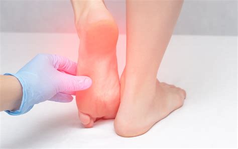 Can Uric Acid Cause Heel Pain? Signs of Gout in the Heel | Heel That Pain