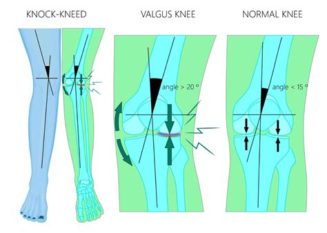 Distal Femoral Osteotomy | Valgus Knee Malalignment | Sugar Land, Pearland, Houston, TX