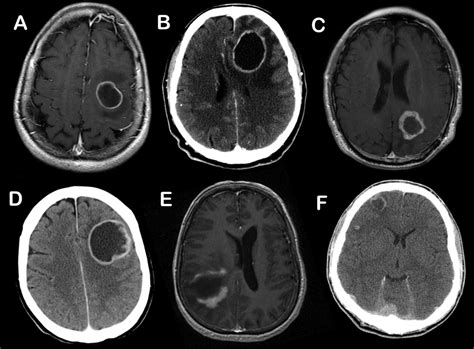 what happens in the final stages of glioblastoma - Maryln Sorenson