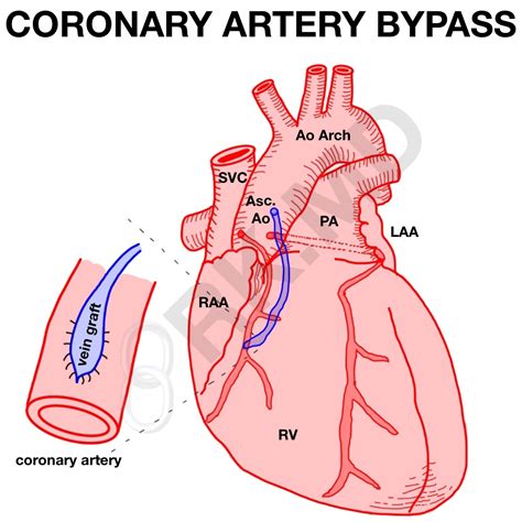 Coronary Artery Bypass Graft