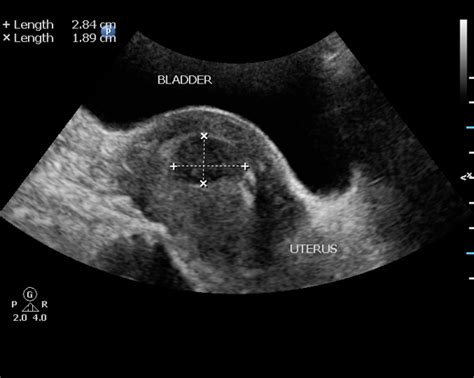 Pin on OB/Gyn Ultrasound 101 Mod 2