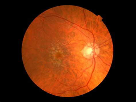 Macular Degeneration - The Retina Centers of Washington