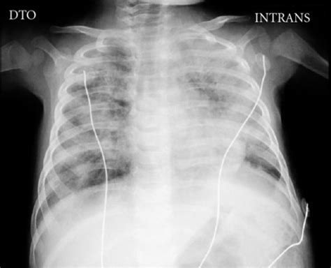 Severe Combined Immunodeficiency (SCID) | Concise Medical Knowledge