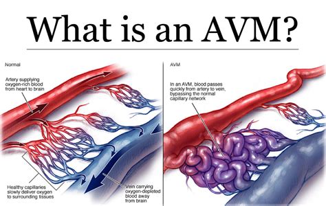 Arteriovenous Malformation Symptoms Types Stages Causes Treatment | My XXX Hot Girl