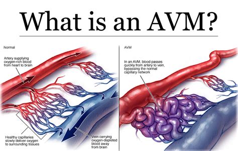 Arteriovenous Malformation - Brain Avm - Causes, Symptoms, Treatment